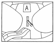 radiation-implant-brief-step-1